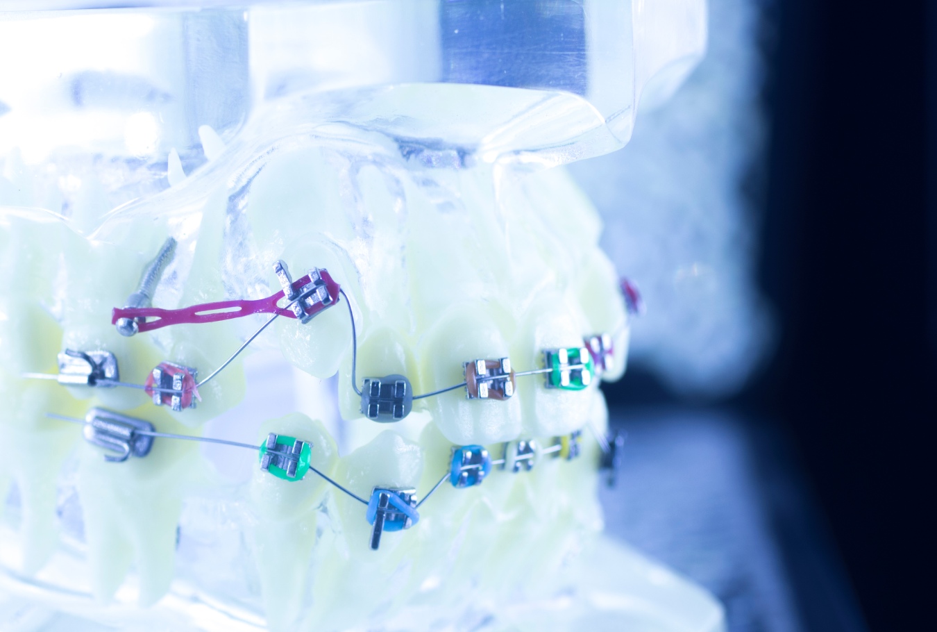 Close-up of a braces model showing brackets and wires